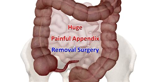 Does appendix removal affect life expectancy?